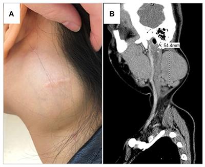 Case Report: Hyper IgE, but Not the Usual Suspects–Kimura Disease in an Adolescent Female